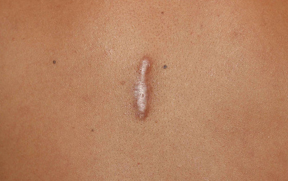 Gunakan Cara Ini Agar Keloid di Tubuhmu Segera Hilang!