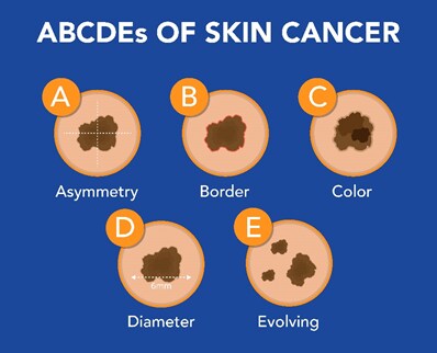 Wellbeing presentation - Early detection and treatment of Skin Cancer